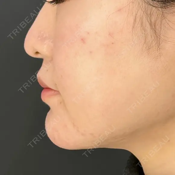 糸リフト / 脂肪吸引（顔） / ボトックス（エラ・小顔） HAAB×DREAM BEAUTY CLINIC 東京本院 DAY 114 メイン用