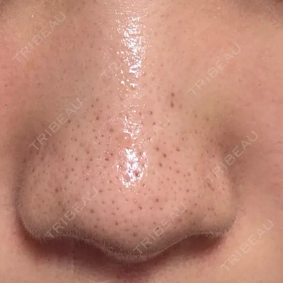 アグネス 日本美容・医療クリニック 六本木院 DAY 9 メイン用