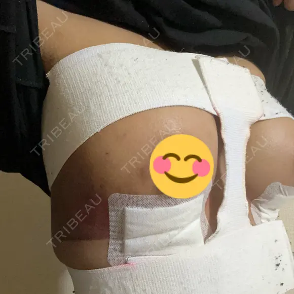 豊胸（シリコンバッグ） / その他（胸） お茶の水美容形成クリニック DAY 3 メイン用