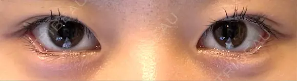 目尻切開 / タレ目形成・グラマラスライン（埋没） LOUIS CLINIC 二子玉川院【ルイクリニック】 DAY 5 メイン用