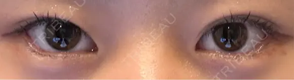 目尻切開 / タレ目形成・グラマラスライン（埋没） LOUIS CLINIC 二子玉川院【ルイクリニック】 DAY 8 メイン用