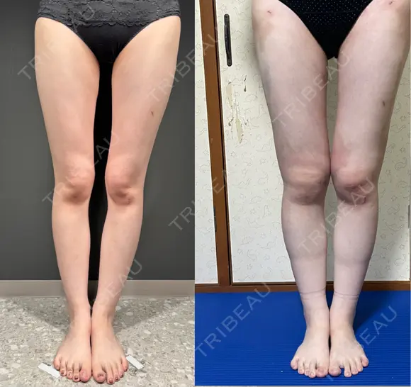 脂肪吸引（二の腕） / 脂肪吸引（脚） / 豊胸（脂肪注入） BBC銀座院 DAY 3 メイン用