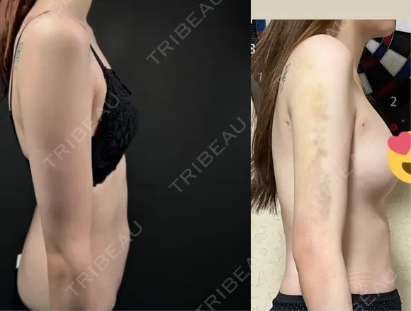 脂肪吸引（二の腕） / 脂肪吸引（脚） / 豊胸（脂肪注入） BBC銀座院 DAY 3 メイン用