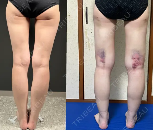 脂肪吸引（二の腕） / 脂肪吸引（脚） / 豊胸（脂肪注入） BBC銀座院 DAY 3 メイン用