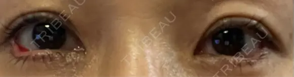 目尻切開 / タレ目形成・グラマラスライン（埋没） LOUIS CLINIC 二子玉川院【ルイクリニック】 DAY 11 メイン用