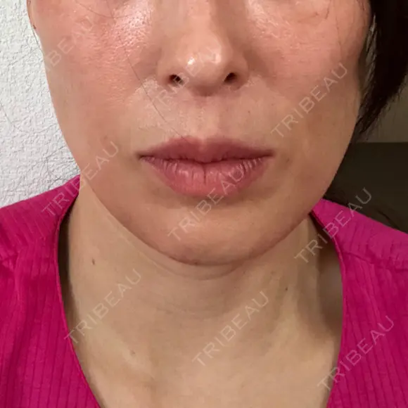 脂肪吸引注射（顔） 湘南美容クリニック 甲府院 DAY 14 メイン用