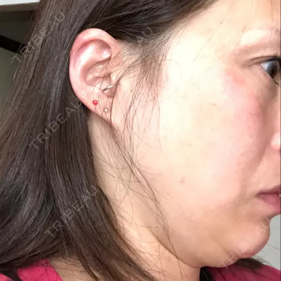 脂肪吸引注射（顔） 湘南美容クリニック 甲府院 DAY 15 メイン用