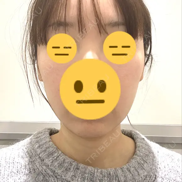 脂肪吸引注射（顔） ルラ美容クリニック 名古屋栄院 / ルラスキンクリニック 名古屋栄院 DAY 10 メイン用