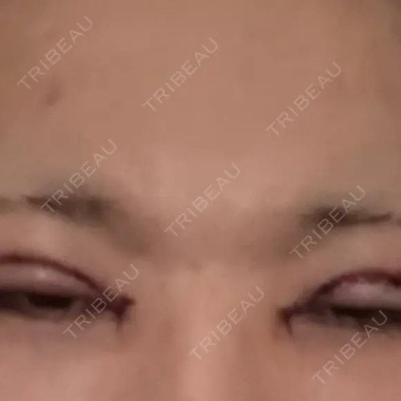 二重切開 / 目頭切開 池袋麗歯科・美容皮膚科 AFTER メイン用