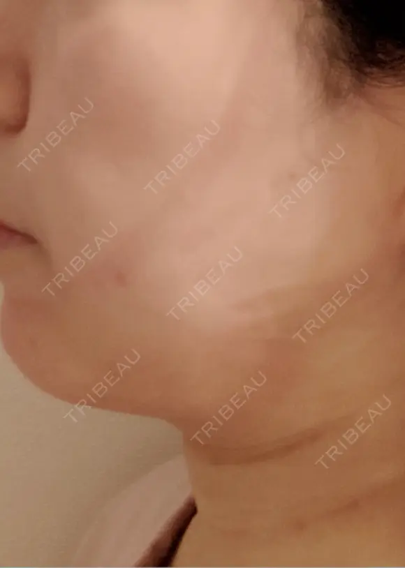 脂肪吸引（顔） / 眉下切開 / ヒアルロン酸注入（首） 春山記念病院 DAY 1 メイン用