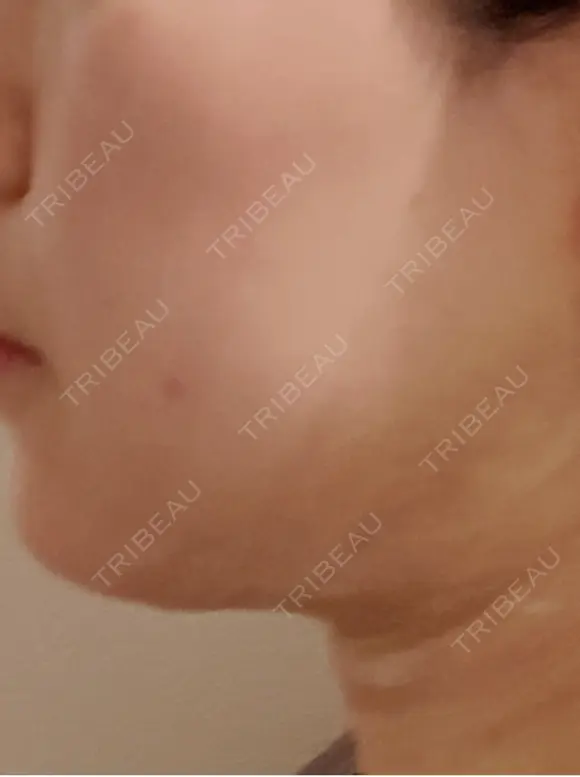 脂肪吸引（顔） / 眉下切開 / ヒアルロン酸注入（首） 春山記念病院 DAY 2 メイン用