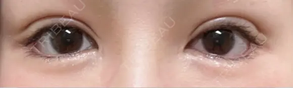 二重切開 / 眼瞼下垂（切開） ユア美容クリニック 福岡院 DAY 9 メイン用