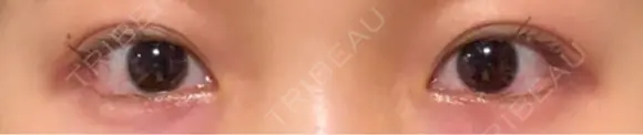 目尻切開 / タレ目形成・グラマラスライン（埋没） / ボトックス（エラ・小顔） LOUIS CLINIC 二子玉川院【ルイクリニック】 AFTER メイン用