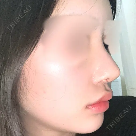 鼻尖形成（切開） / 軟骨移植 / 骨切幅寄せ / ワシ鼻修正・ハンプ切除 WOM CLINIC GINZA （ワム クリニック ギンザ） DAY 9 メイン用