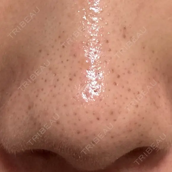 アグネス 日本美容・医療クリニック 六本木院 DAY 10 メイン用