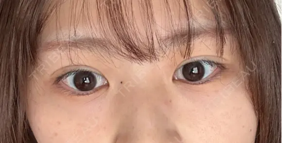 二重埋没 9BeautyClinic AFTER メイン用