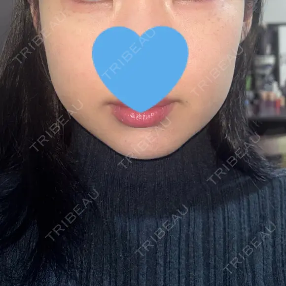 RF（高周波）たるみ治療 LUNA BEAUTY CLINIC 池袋駅前院 DAY 36 メイン用