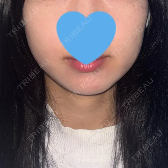 RF（高周波）たるみ治療 LUNA BEAUTY CLINIC 池袋駅前院 AFTER メイン用
