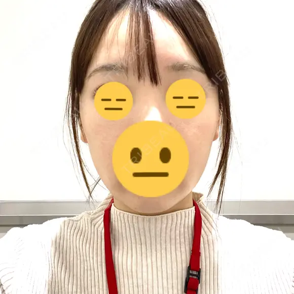 脂肪吸引注射（顔） ルラ美容クリニック 名古屋栄院 / ルラスキンクリニック 名古屋栄院 DAY 11 メイン用