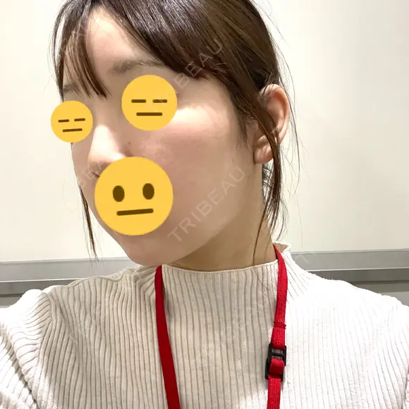 脂肪吸引注射（顔） ルラ美容クリニック 名古屋栄院 / ルラスキンクリニック 名古屋栄院 DAY 11 メイン用