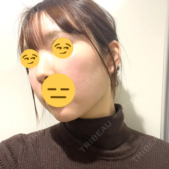 脂肪吸引注射（顔） ルラ美容クリニック 名古屋栄院 / ルラスキンクリニック 名古屋栄院 DAY 9 メイン用