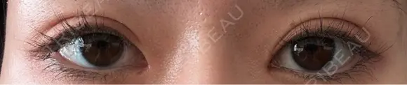 目頭切開 9BeautyClinic AFTER メイン用