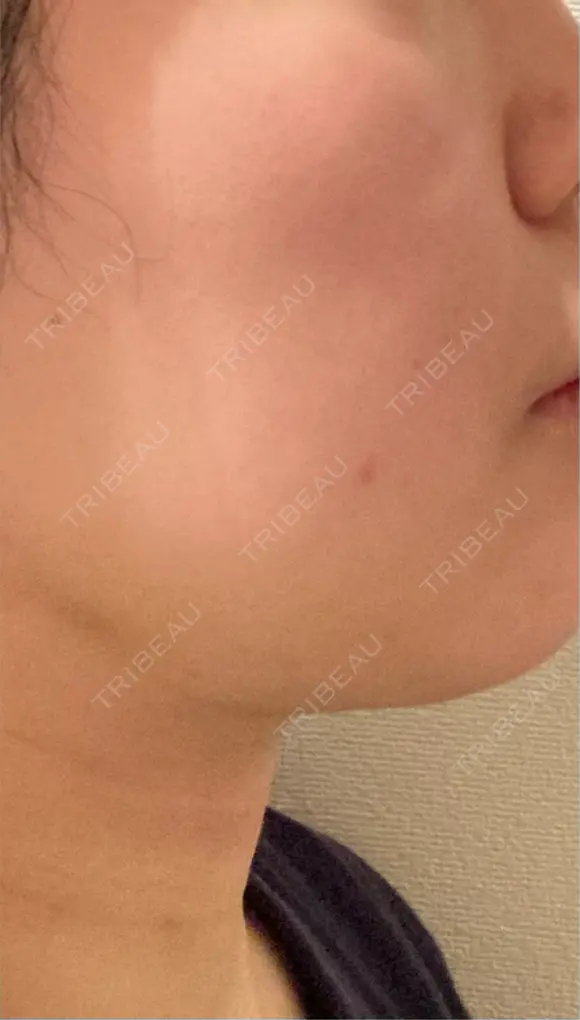 脂肪吸引（顔） / 眉下切開 / ヒアルロン酸注入（首） 春山記念病院 DAY 4 メイン用