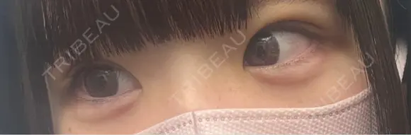 ヒアルロン酸注入（涙袋） Olino美容外科・美容皮膚科 DAY 0 メイン用