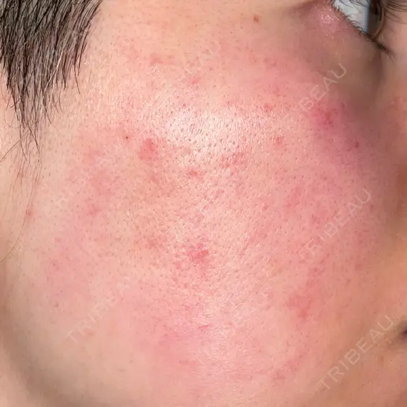 ルメッカ ルラ美容クリニック 大宮院 / ルラスキンクリニック 大宮院 DAY 0 メイン用