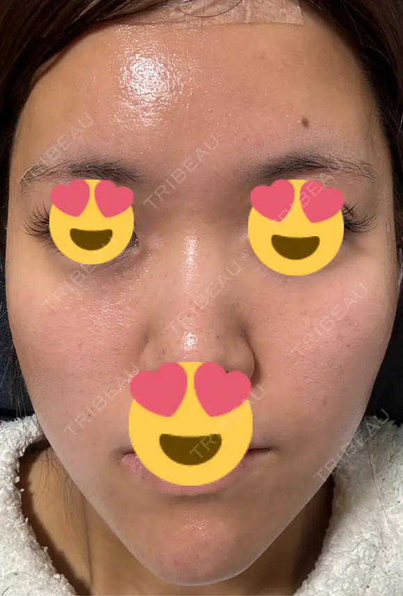 医療脱毛（顔） 日本美容・医療クリニック 六本木院 DAY 1 メイン用