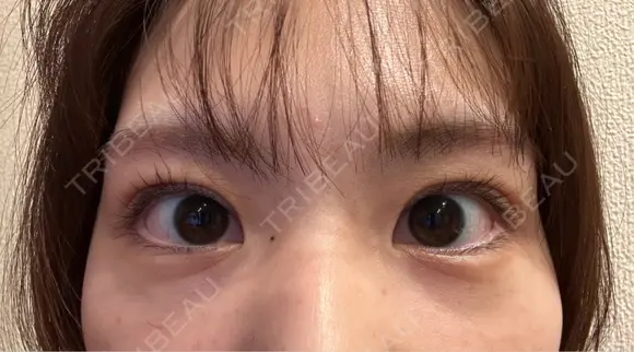 二重埋没 9BeautyClinic DAY 2 メイン用
