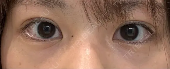 二重埋没 9BeautyClinic DAY 13 メイン用