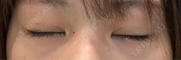 二重埋没 9BeautyClinic DAY 13 メイン用