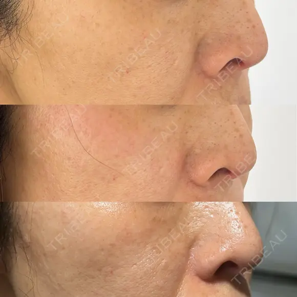 ピコレーザートーニング（美白・肝斑） / フラクショナルレーザー（毛穴・ニキビ跡） Mavie Beauty Clinic （マヴィービューティークリニック） DAY 21 メイン用
