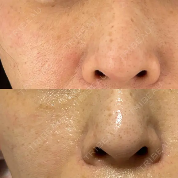 ピコレーザートーニング（美白・肝斑） / フラクショナルレーザー（毛穴・ニキビ跡） Mavie Beauty Clinic （マヴィービューティークリニック） DAY 28 メイン用