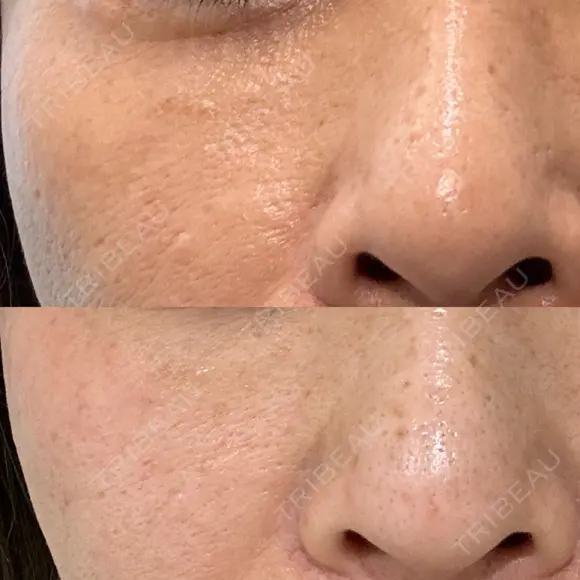 ピコレーザートーニング（美白・肝斑） / フラクショナルレーザー（毛穴・ニキビ跡） Mavie Beauty Clinic （マヴィービューティークリニック） DAY 49 メイン用