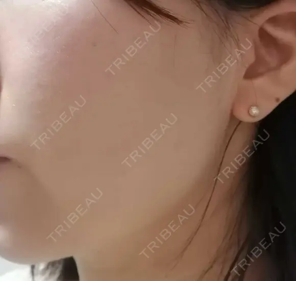 ルメッカ ルラ美容クリニック 静岡院 DAY 3 メイン用