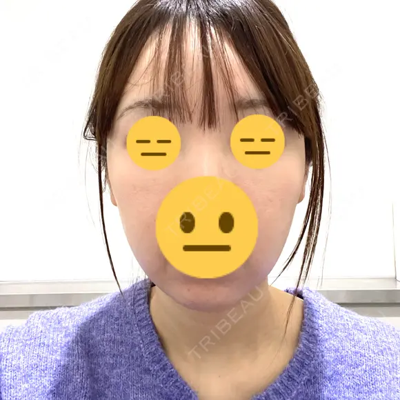 脂肪吸引注射（顔） ルラ美容クリニック 名古屋栄院 / ルラスキンクリニック 名古屋栄院 AFTER メイン用