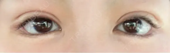 二重切開 / 眼瞼下垂（切開） ユア美容クリニック 福岡院 DAY 11 メイン用