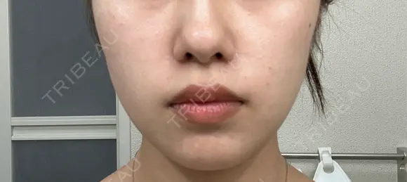 ボトックス（エラ・小顔） / ボトックス（肩） / ワキ汗治療（ボトックス） おおたかの森ビューティークリニック DAY 3 メイン用