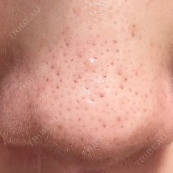 アグネス 日本美容・医療クリニック 六本木院 DAY 11 メイン用