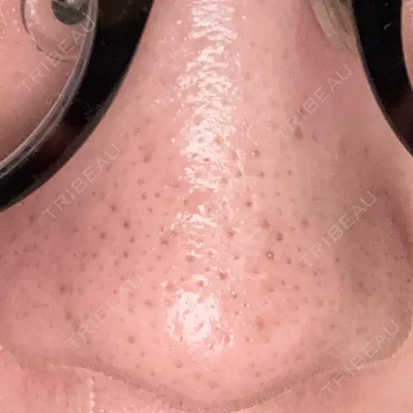 アグネス 日本美容・医療クリニック 六本木院 DAY 12 メイン用