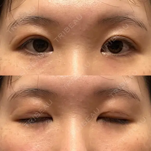 二重切開 / 眼瞼下垂（切開） / 上まぶたたるみ取り ユア美容クリニック 福岡院 DAY 17 メイン用