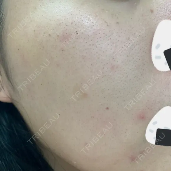 ルメッカ Belle Via Skin Clinic DAY 5 メイン用