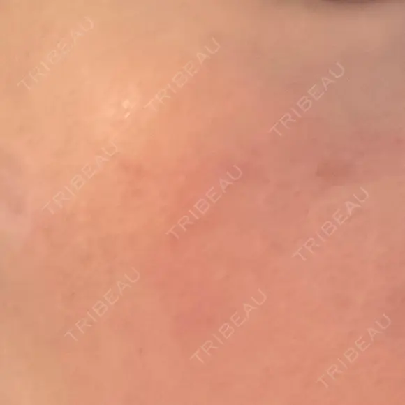 ニードルRF（ポテンツァなど） 広島プルミエクリニック DAY 6 メイン用