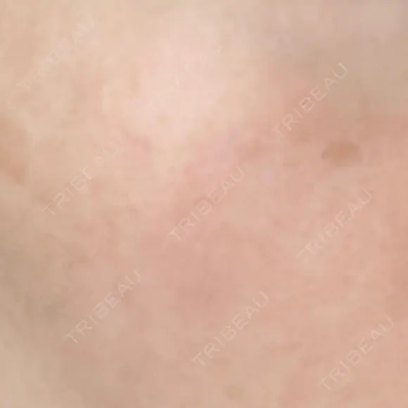 ニードルRF（ポテンツァなど） 広島プルミエクリニック DAY 7 メイン用