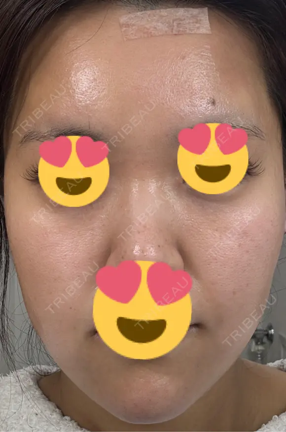 医療脱毛（顔） 日本美容・医療クリニック 六本木院 DAY 2 メイン用