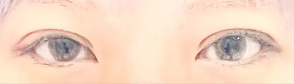 二重埋没 / 上まぶたの脂肪取り / ボトックス（額） 9BeautyClinic DAY 19 メイン用