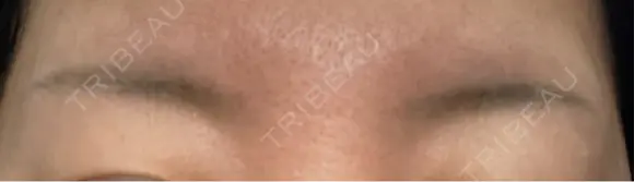 アートメイク除去・修正 渋谷美容外科クリニック 新宿院 AFTER メイン用