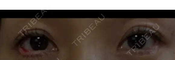 目尻切開 / タレ目形成・グラマラスライン（埋没） LOUIS CLINIC 二子玉川院【ルイクリニック】 DAY 14 メイン用